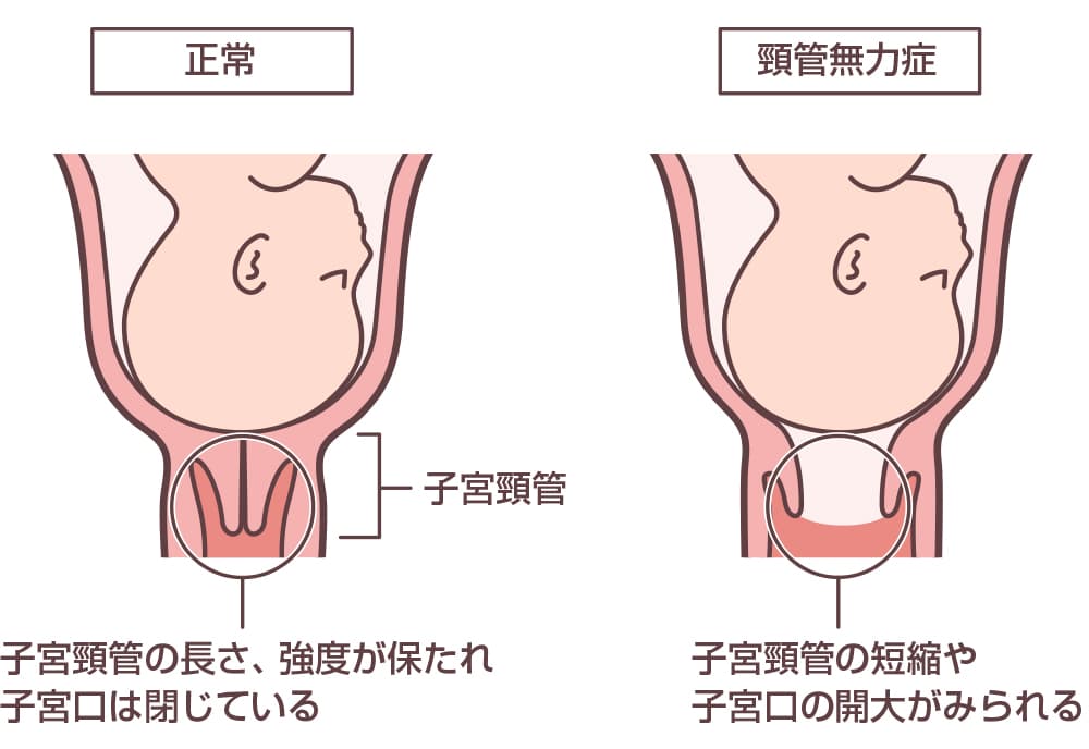 切迫早産の原因